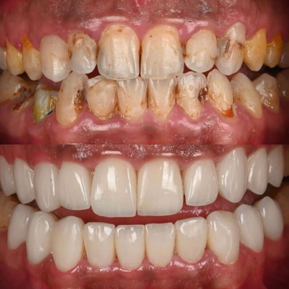 حالة قبل وبعد — تركيبات وتجميل الأسنان