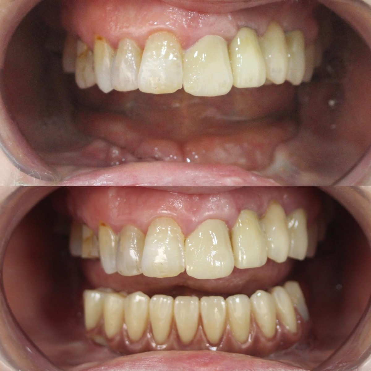 حالة قبل وبعد — تجميل الأسنان
