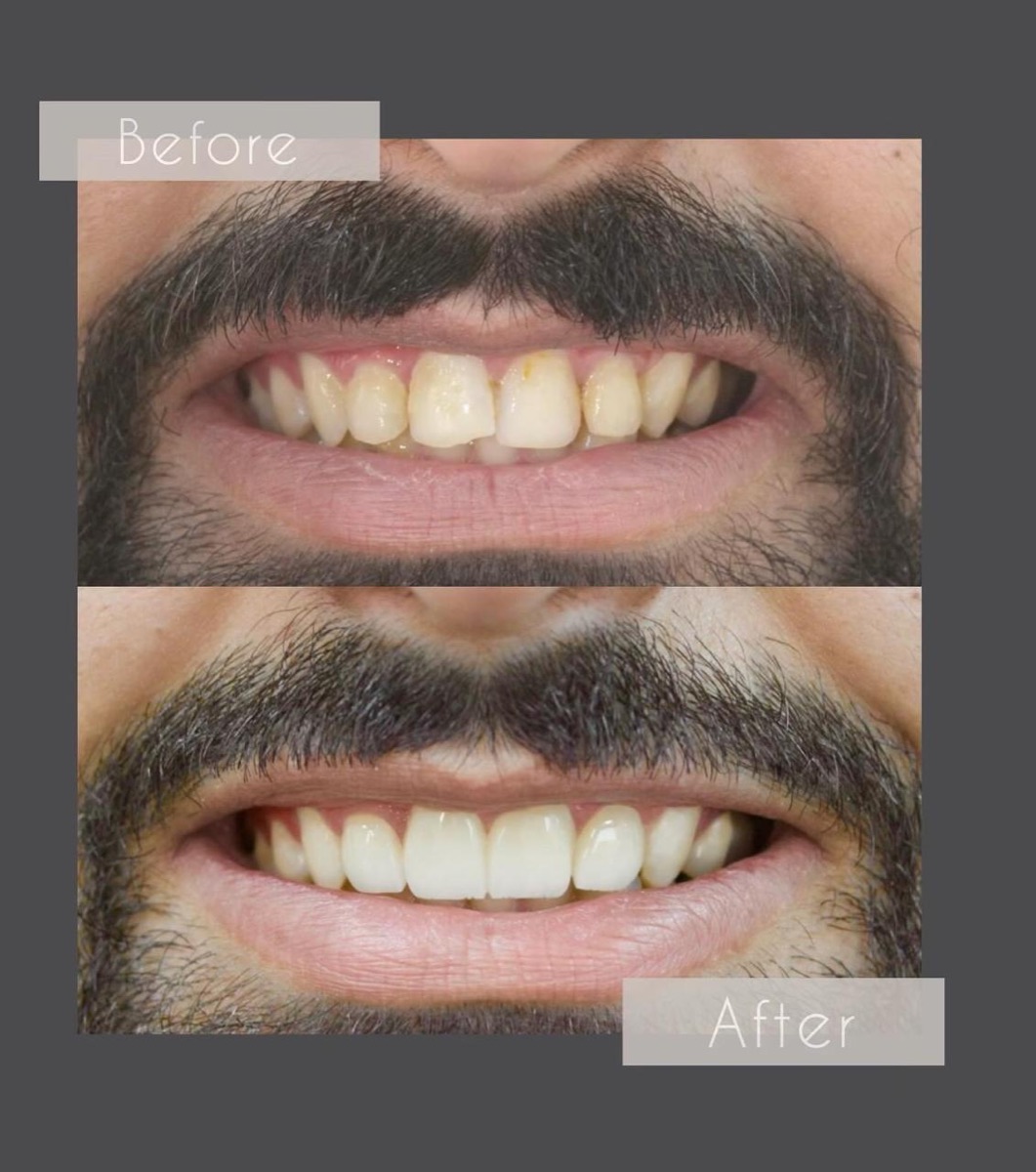 حالة قبل وبعد — علاج تجميلي متكامل